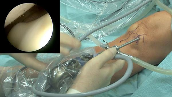 livekneesurgery