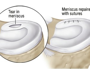 meniscus