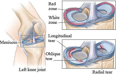 meniscus tear zones