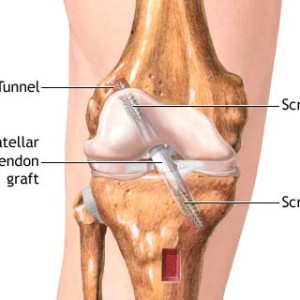 tornligamentreconstruction